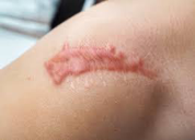 Scar Revision Surgery in Borivali Mumbai